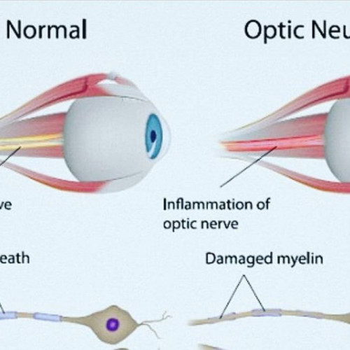 Problemele de vedere și diagnosticul de nevrită optic în atenția specialiștilor din Iași