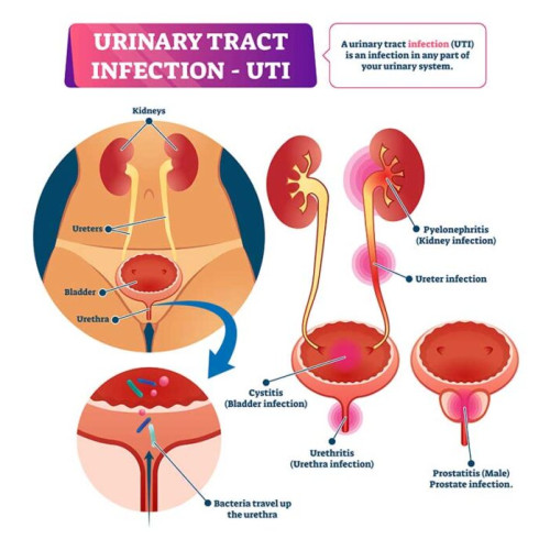 Problemele infectiilor urinare la femei: sfaturi si informatii utile