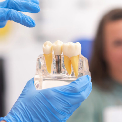 Implantul dentar: soluția modernă pentru un zâmbet fără durere