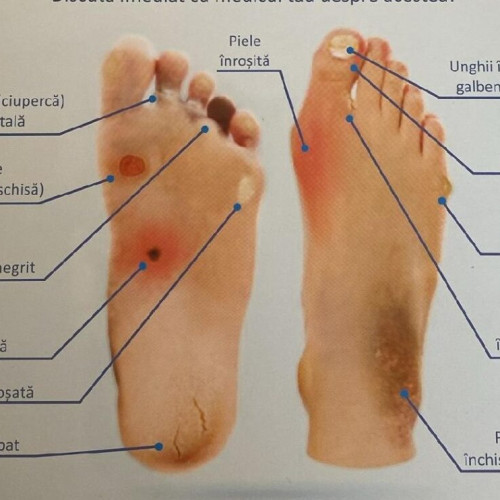 Problemele diabetului și importanța îngrijirii picioarelor