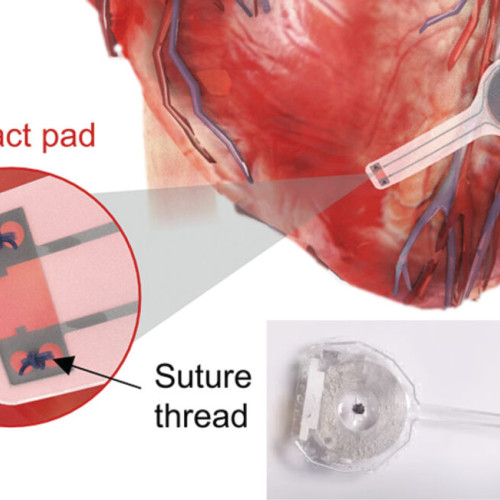 Un nou tip de stimulator cardiac poate corecta aritmia în situații de urgență