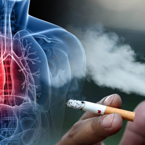 Tratamentul paliativ, o soluție pentru pacienții cu cancer pulmonar