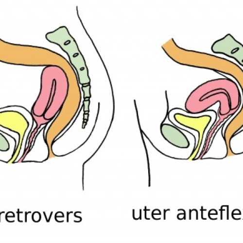 Uterul retroversat: informații și sfaturi pentru femeile care doresc o sarcină