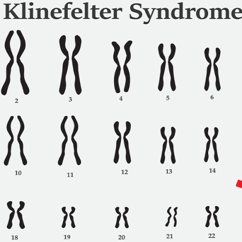 Cercetările recente asupra sindromului Klinefelter oferă speranțe în tratarea infertilității la bărbați