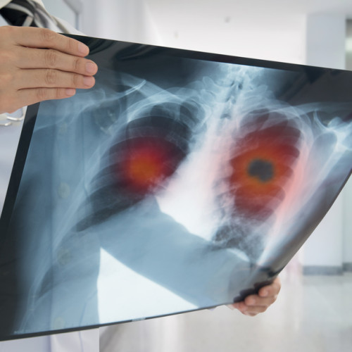 Răspunsul Uniunii Europene la incidența cancerului: creștere și inegalități