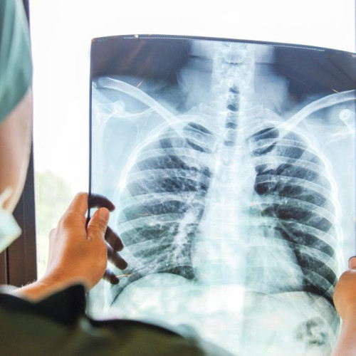 Iasi, al doilea județ cu cele mai multe cazuri de tuberculoză tratate în ambulatoriu