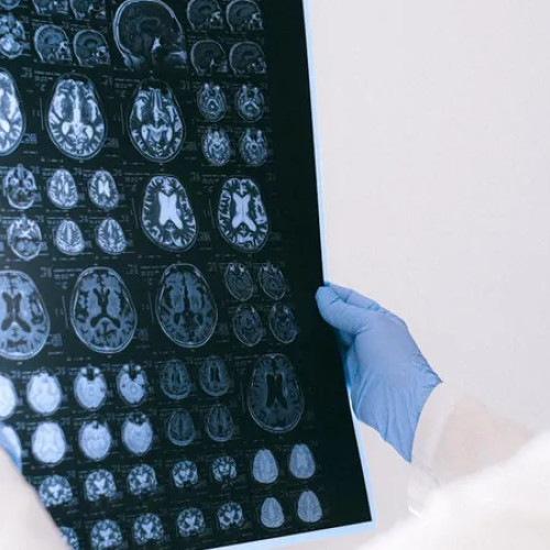 UE nu aprobă medicamentele pentru Alzheimer