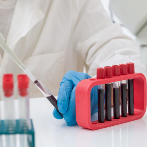 cercetare promițătoare pentru detectarea timpurie a cancerului bazată pe analiza plasmei sanguine