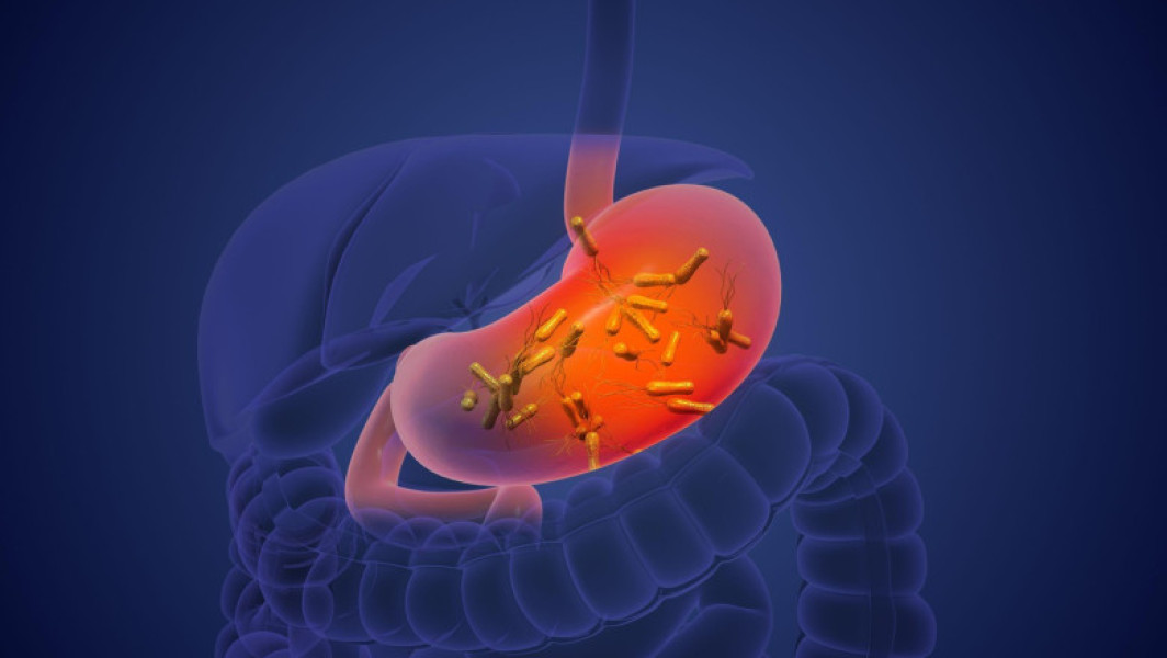 Cancerul de stomac, un pericol major global, poate fi prevenit în mare măsură