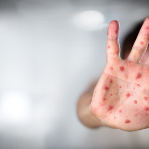 Decesul unui copil cu rujeola în Liverpool reia discuțiile despre vaccinare în Marea Britanie