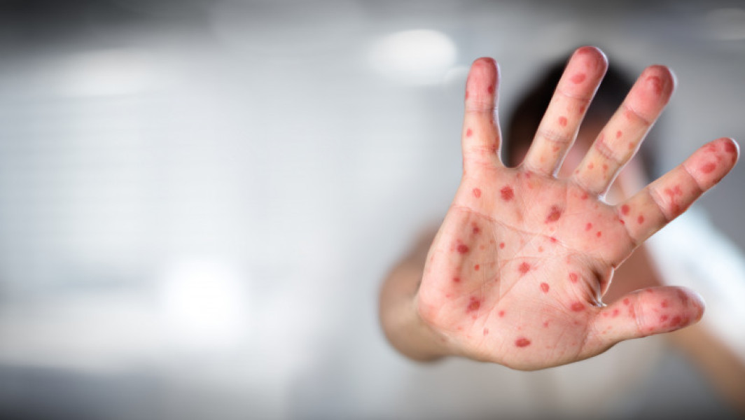 Copil de 2 ani diagnosticat cu tuse convulsivă şi rujeolă. Copilul nu a făcut niciun vaccin de când s-a născut
