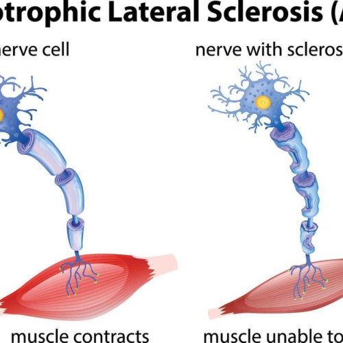 Descoperire revoluționară în lupta împotriva sclerozei laterale amiotrofice