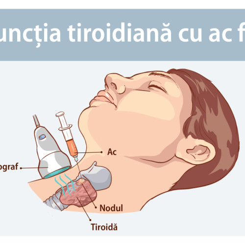 Creșterea Incidenței Nodulilor Tiroidieni la Femei pe Măsură ce Îmbătrânesc